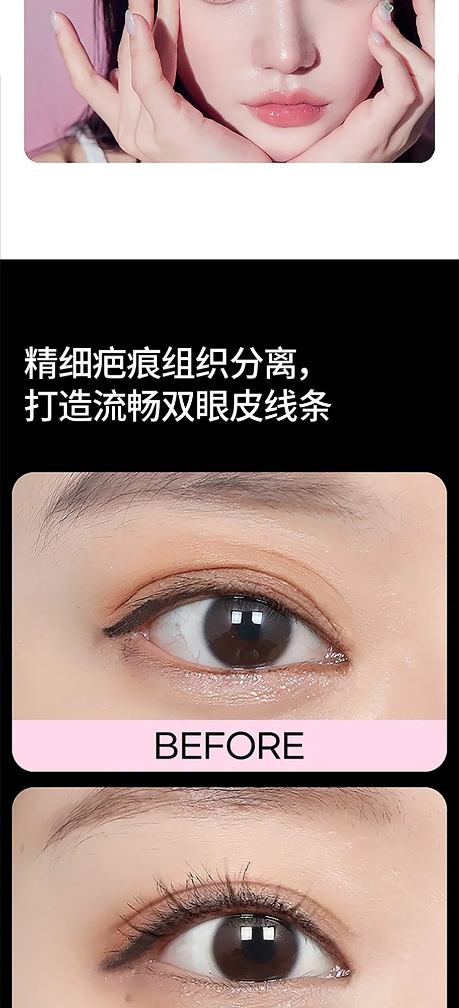 20260626_세미아웃눈재수술_강남언니_컨텐츠_중문 (2/8)