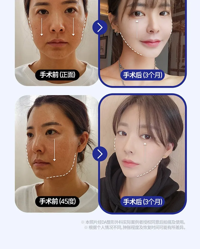 20260624_수직미니거상_강남언니_컨텐츠_중문 (8/8)