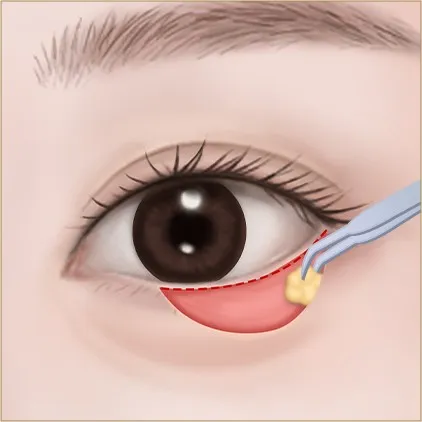 Under-eye fat 1