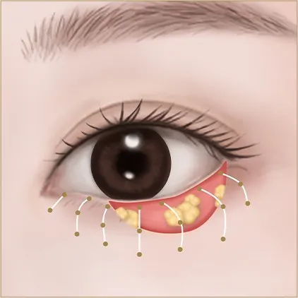 Under-eye fat 2