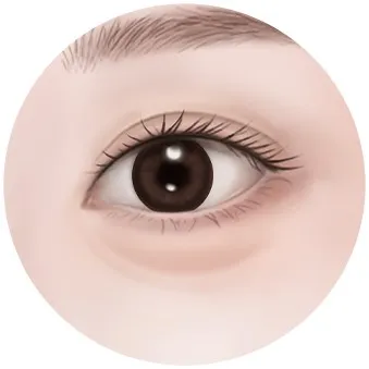 Under-eye fat in the 30s
