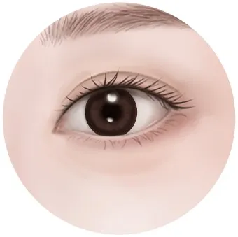Under-eye fat in the 20s