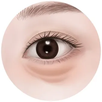 Under-eye fat in the 40s