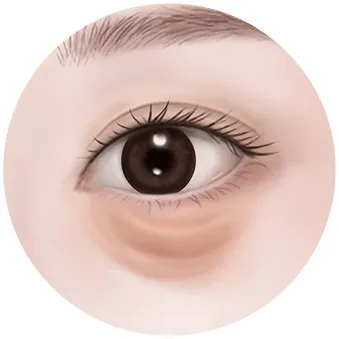 Under-eye fat in the 50s