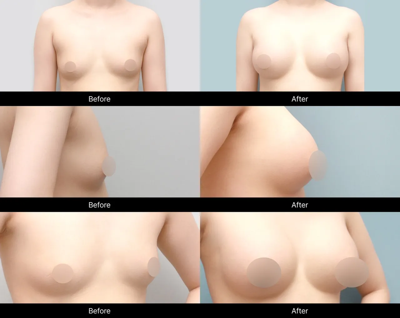 Motiva breast augmentation before-and-after images