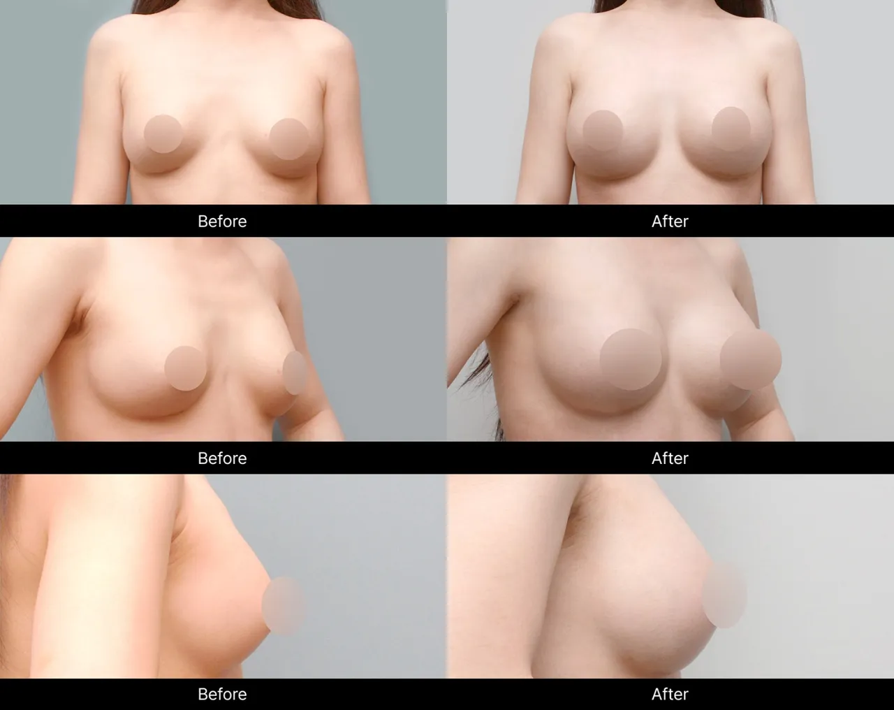 Before-and-after images of breast revision surgery