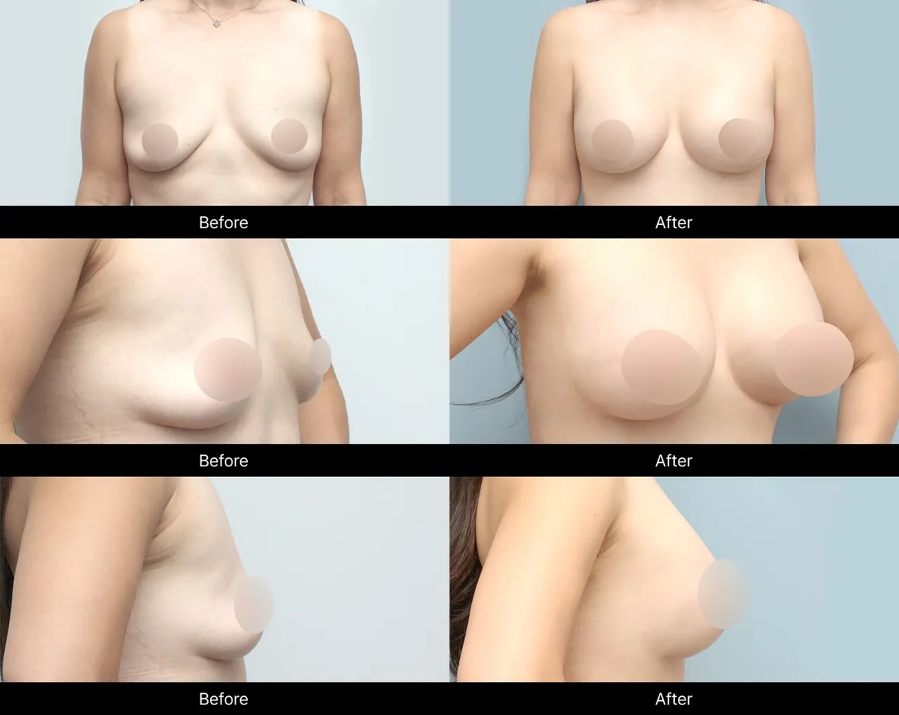 Before-and-after images of postpartum breast surgery