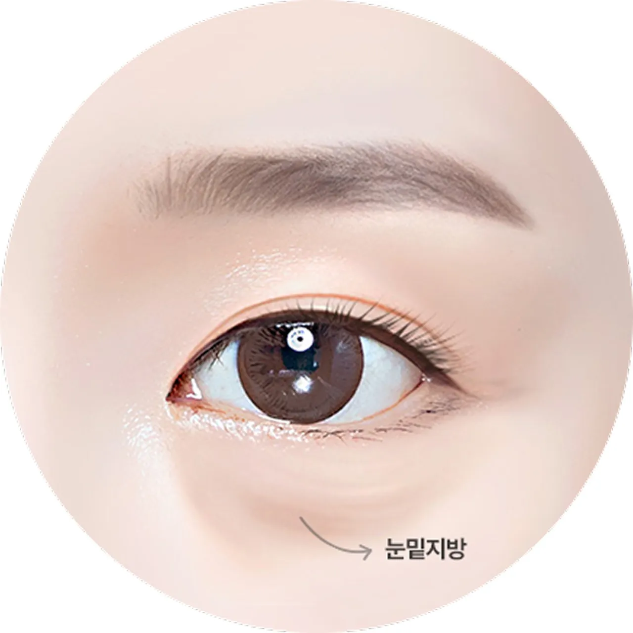Under-eye fat image