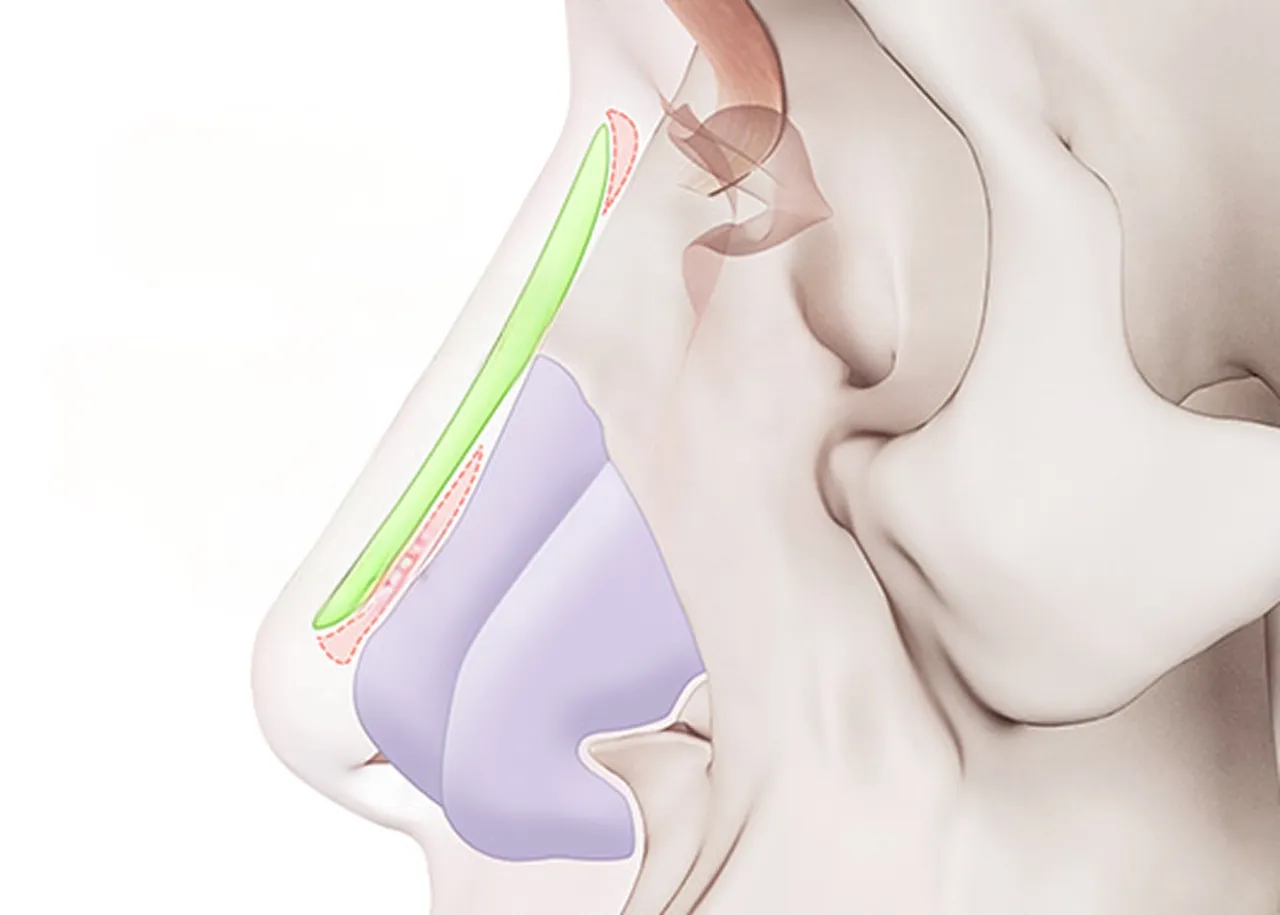 Standard implant image