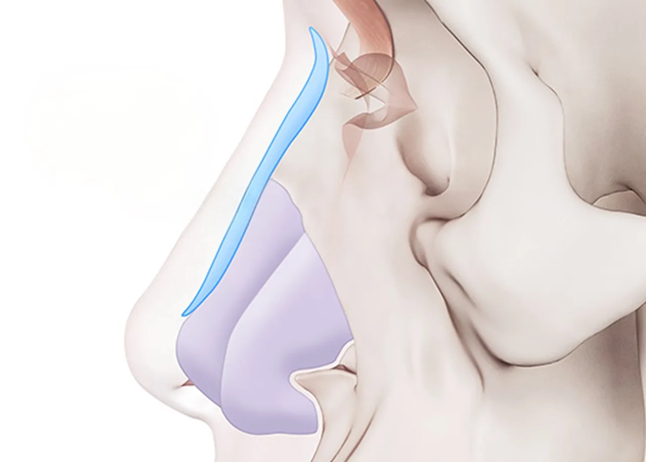 Marvel Inofit custom rhinoplasty image
