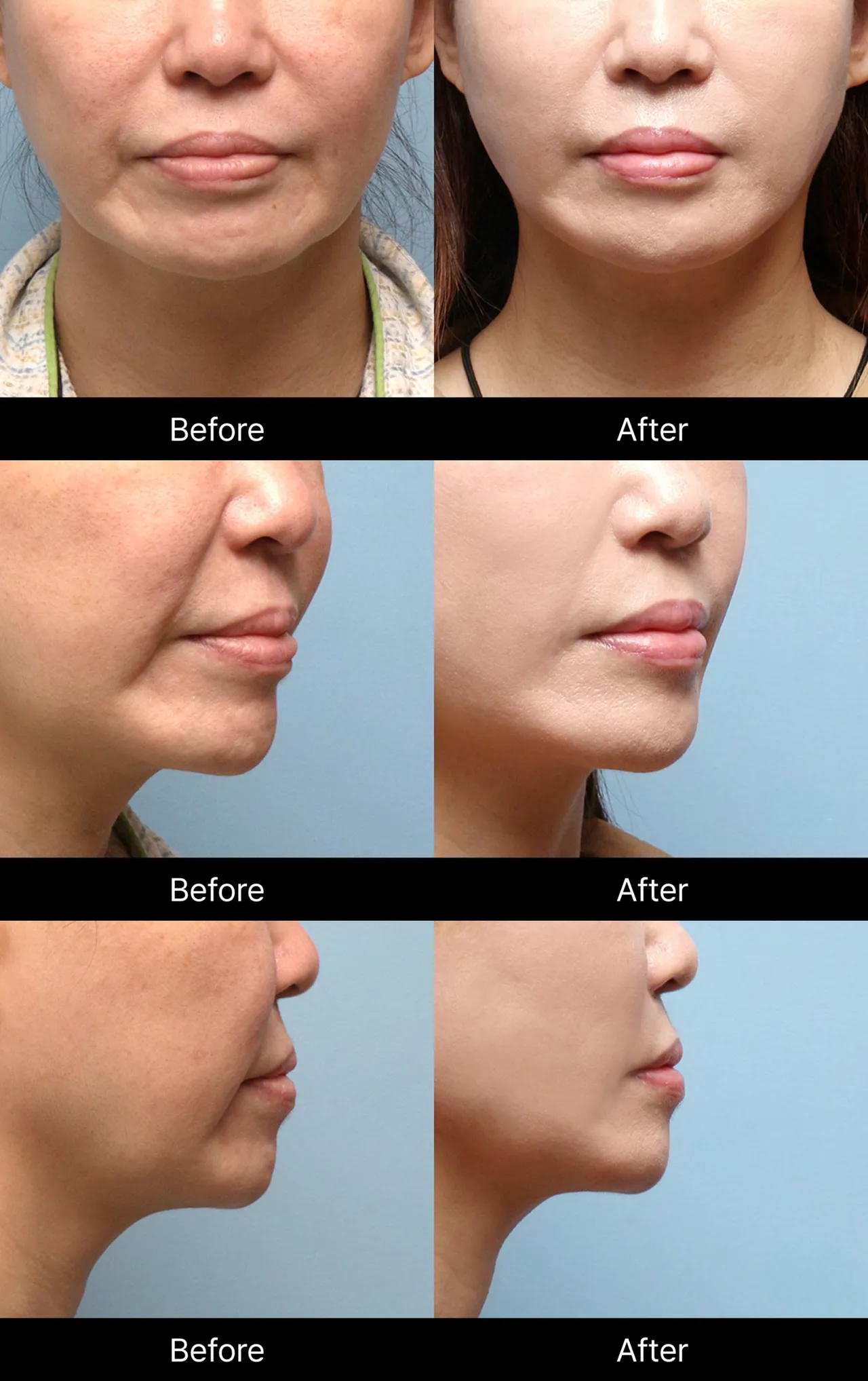 Facelift before-and-after image