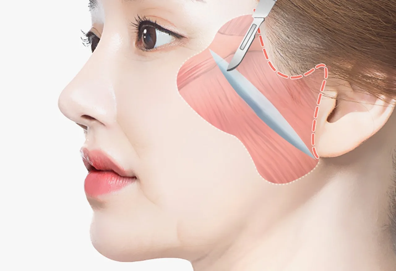 Facelift image