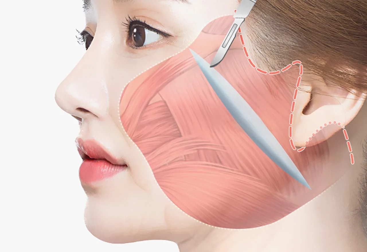 Facelift image 2