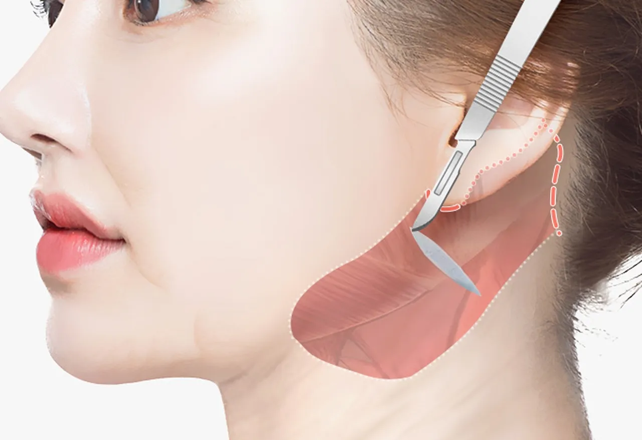 Facelift neck lift image