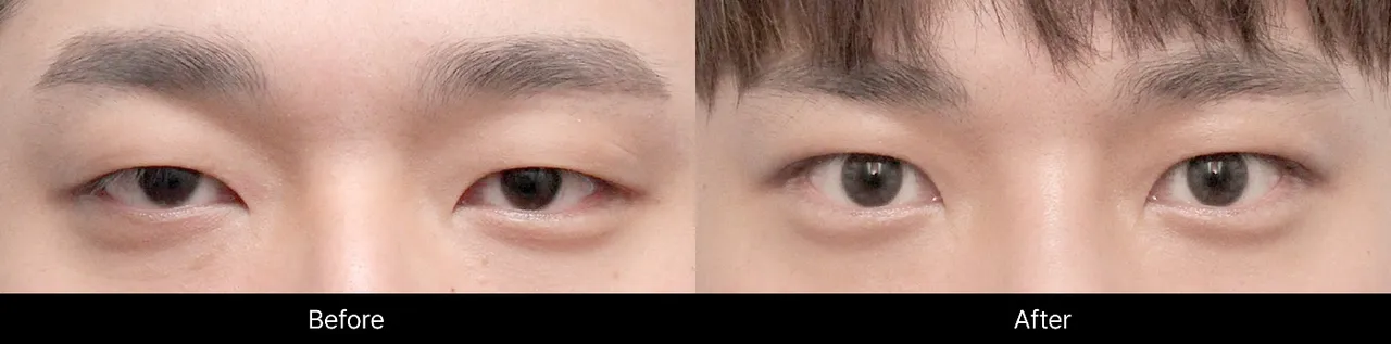Before-and-after images of men's eye surgery