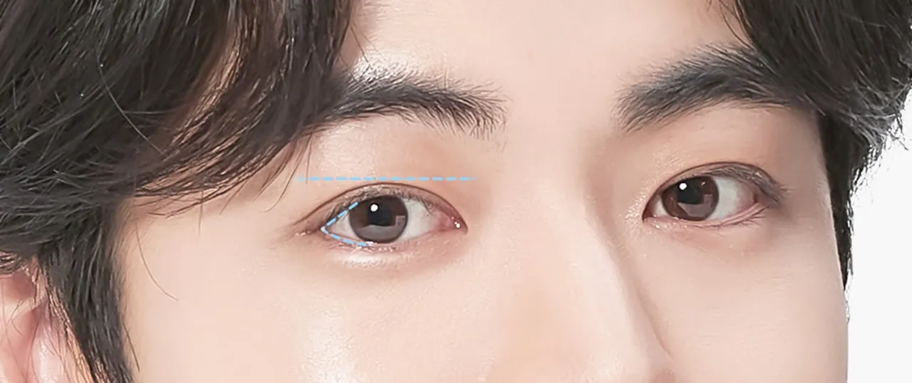 Men's eye surgery model image 2
