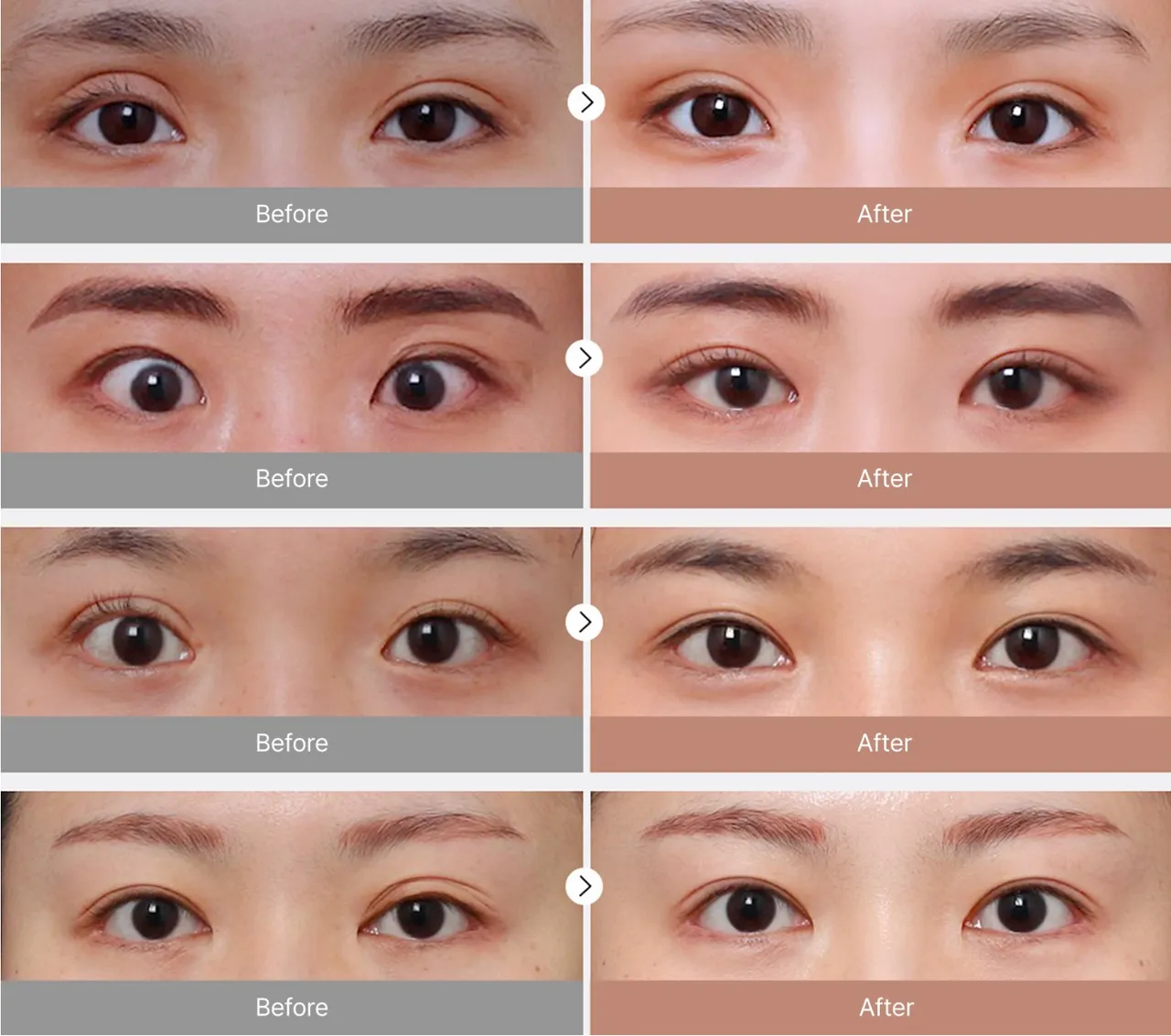 Before-and-after photos of eye revision surgery 1