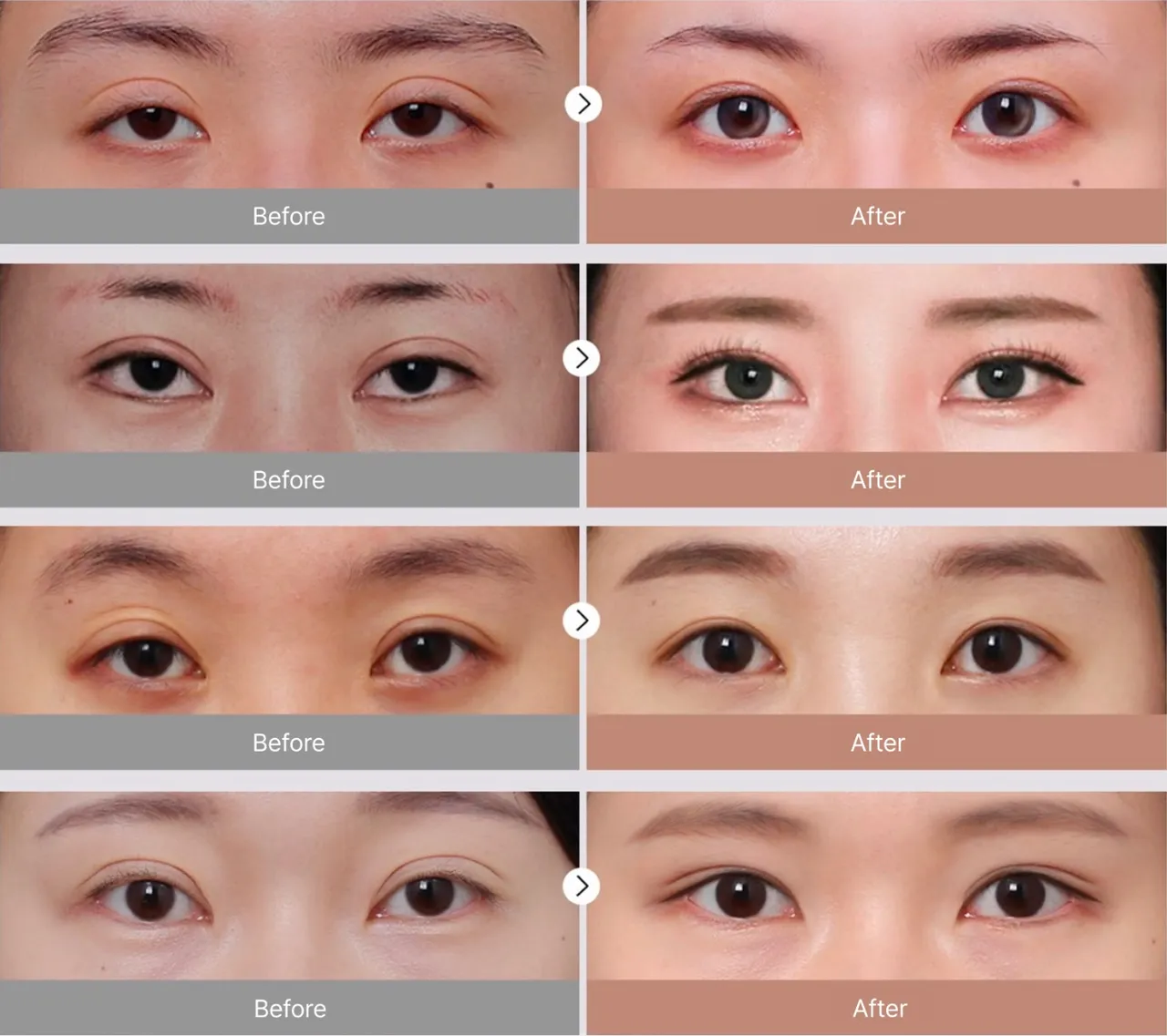 Before-and-after photos of revision eyelid surgery 2