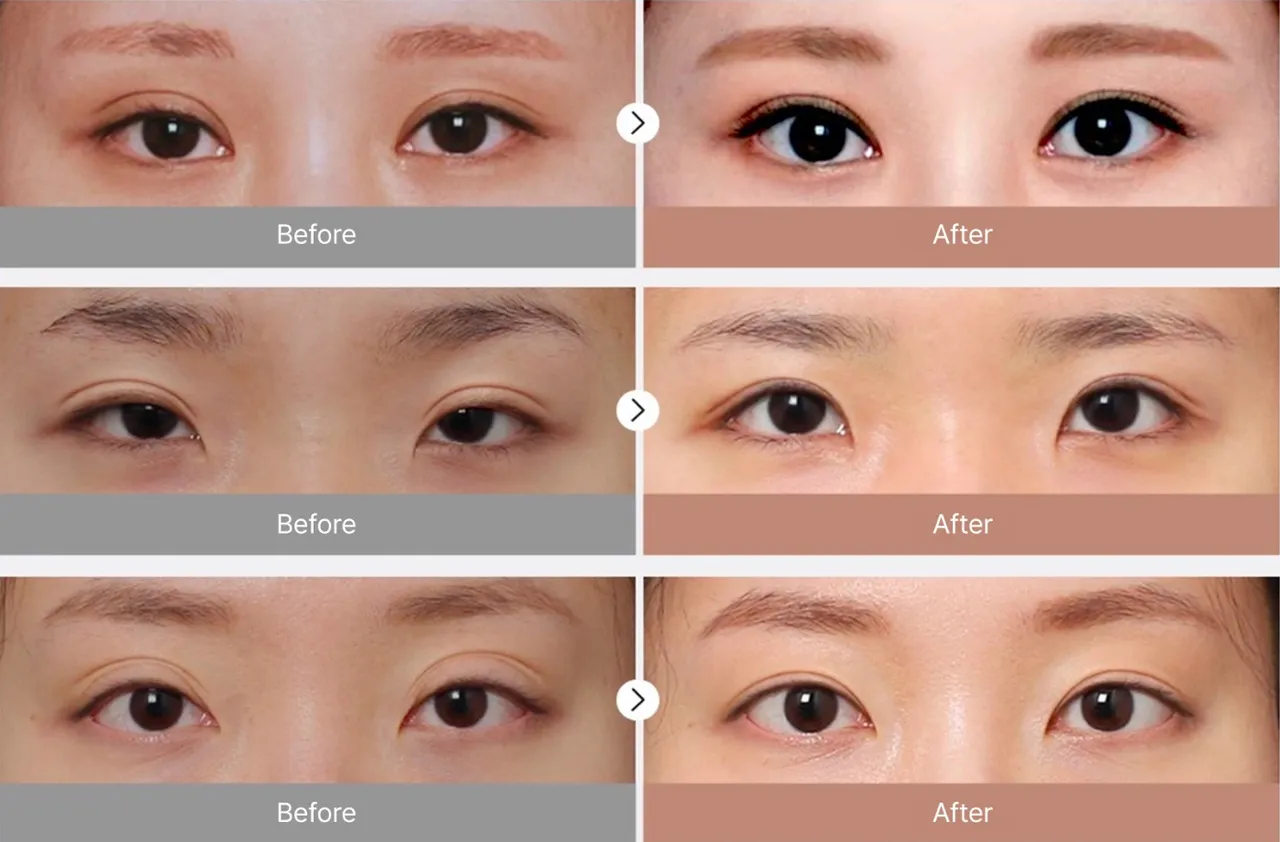 Before-and-after photos of eye revision surgery3