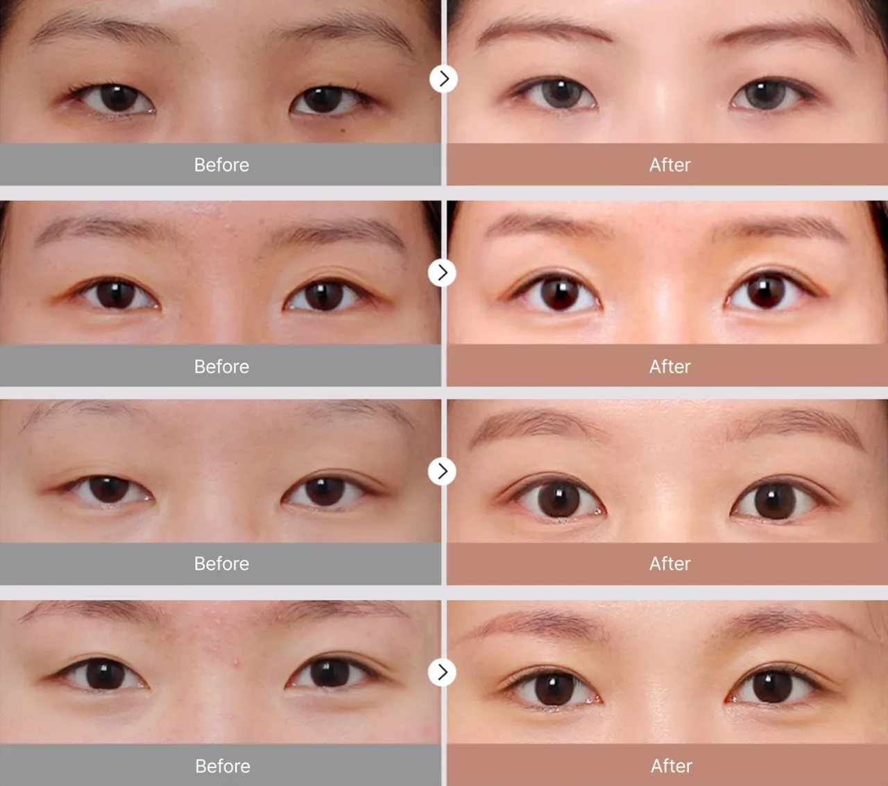 Before-and-after photos of eye revision surgery 4