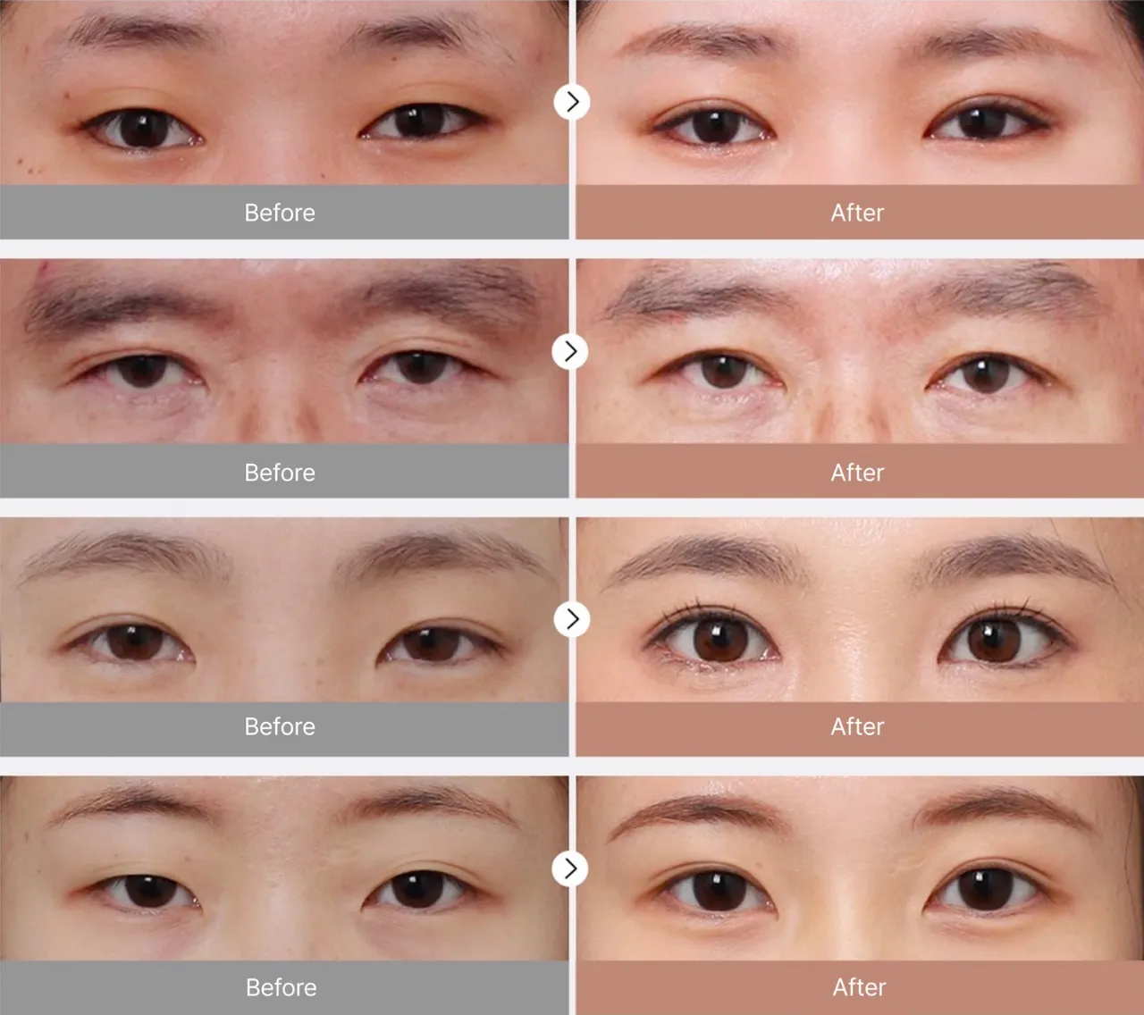 Before and after photos of eye revision surgery 5