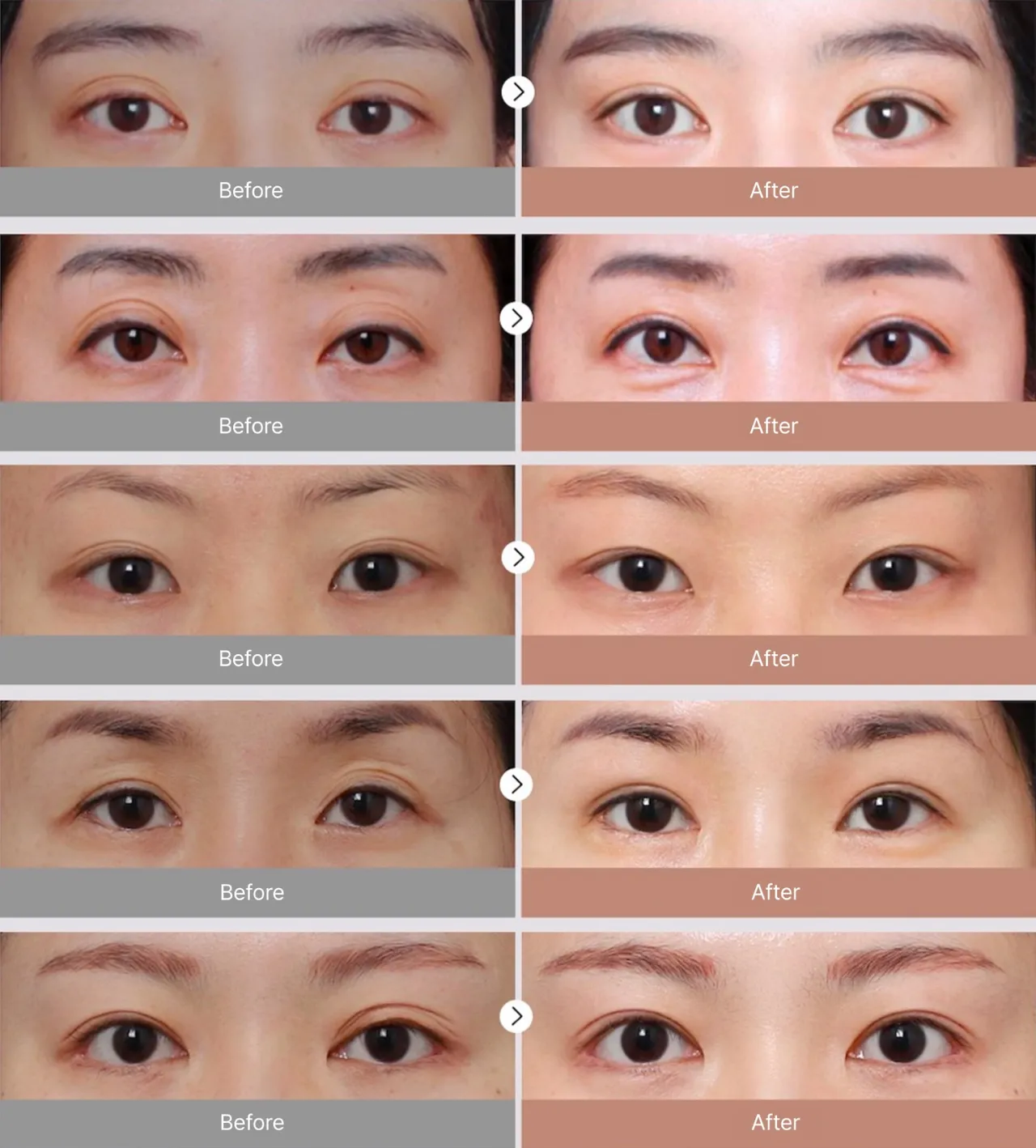 Before-and-after photos of revision eye surgery