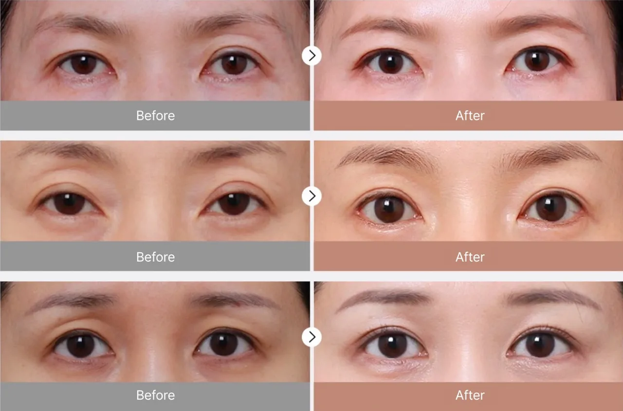 Before-and-after photos of revision eye surgery