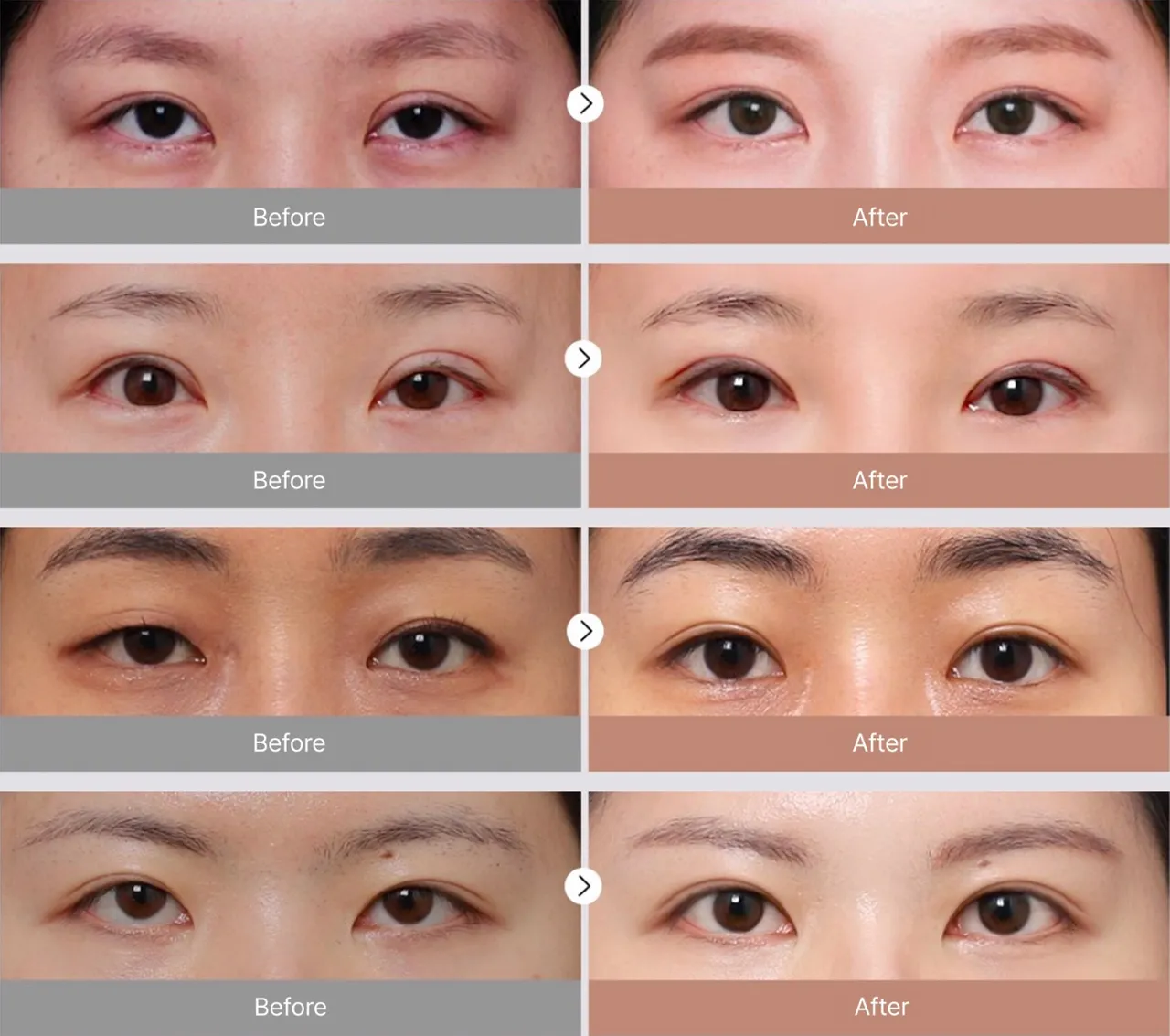 Before-and-after photos of eye revision surgery 8