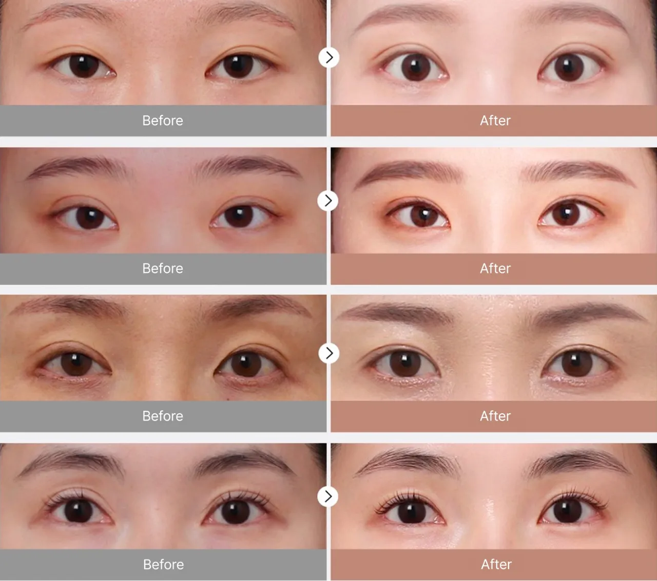 Before-and-after photos of revision eye surgery