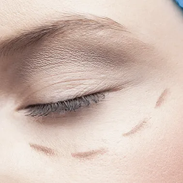 Lower blepharoplasty (Under-eye)