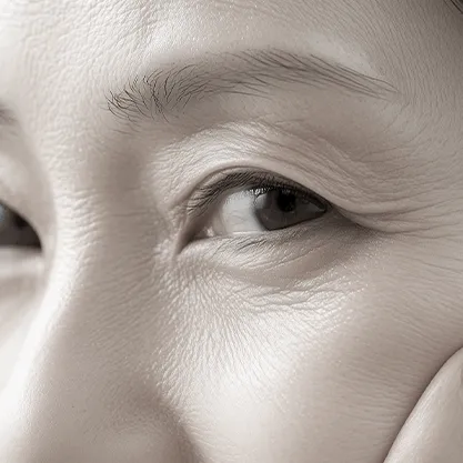 Lower Eyelid Fat Repositioning
