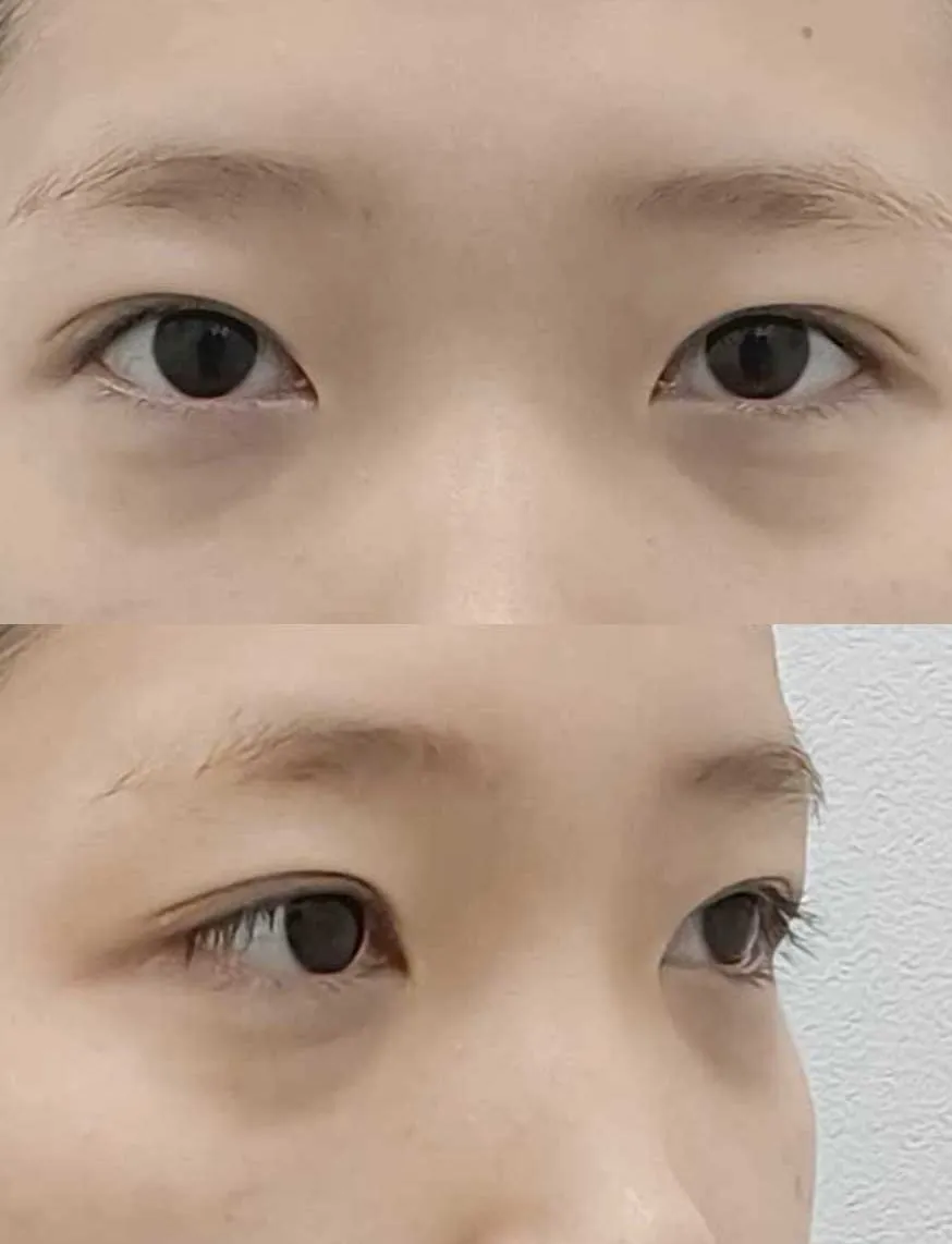 Lower Eyelid Fat Repositioning 2
