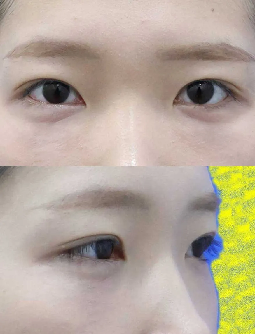 Lower Eyelid Fat Repositioning — Rewind Plastic Surgery 3
