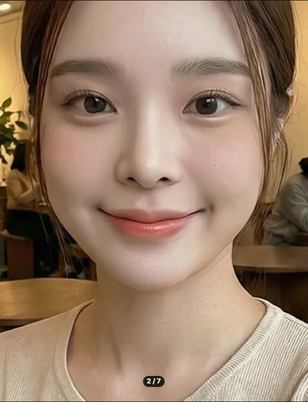 Chin Liposuction — Rewind Plastic Surgery 2