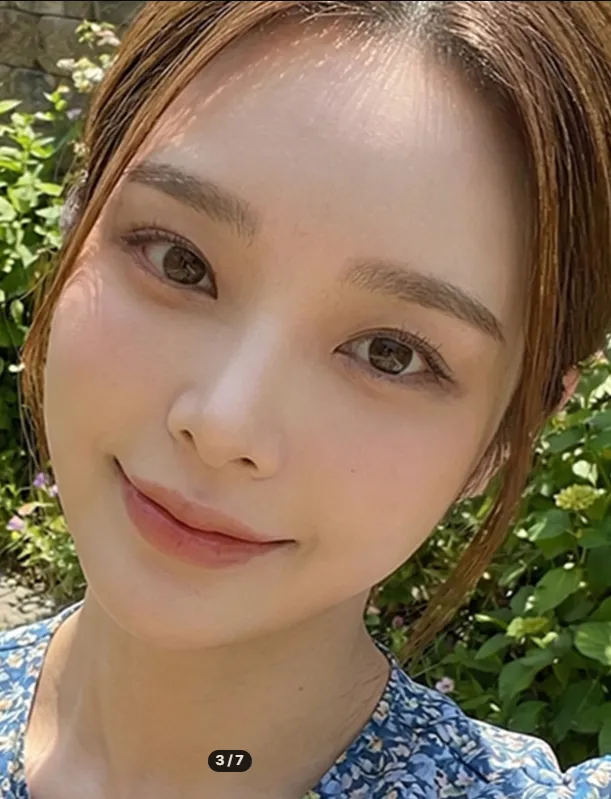 Chin Liposuction — Rewind Plastic Surgery 3