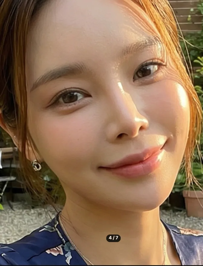 Chin Liposuction — Rewind Plastic Surgery 4