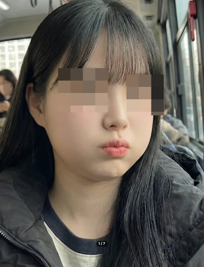 Chin Liposuction — Rewind Plastic Surgery 2