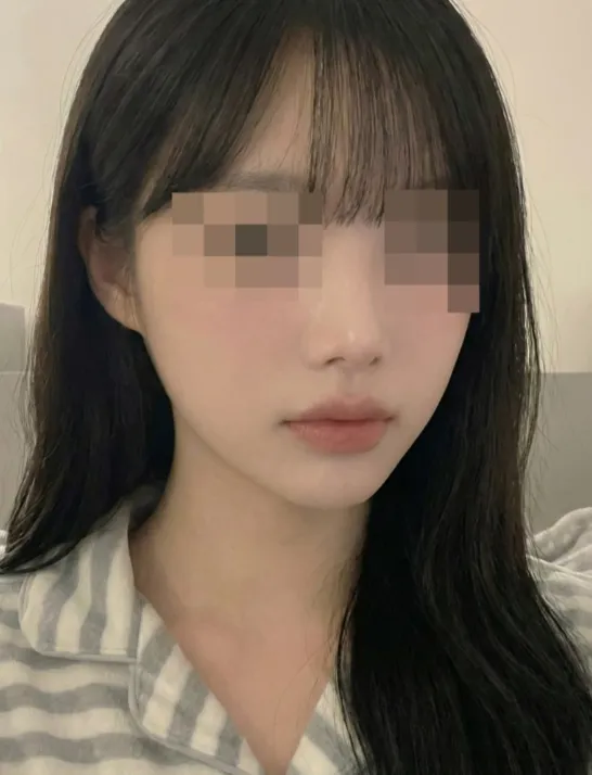 Chin Liposuction — Rewind Plastic Surgery 3