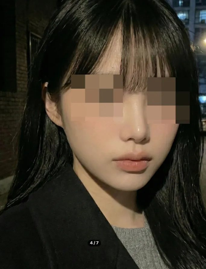 Chin Liposuction — Rewind Plastic Surgery 4