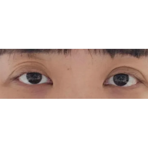 Puffy Eyelid Correction 1