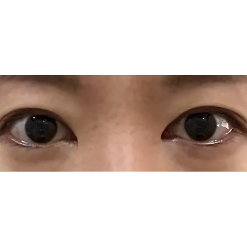 Epicanthoplasty Revision (Reconstruction) 1