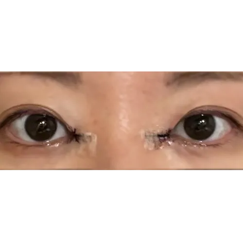 Epicanthoplasty Revision (Reconstruction) 2