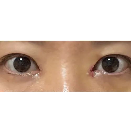 Epicanthoplasty Revision (Reconstruction) — Afternoon Plastic Surgery 3