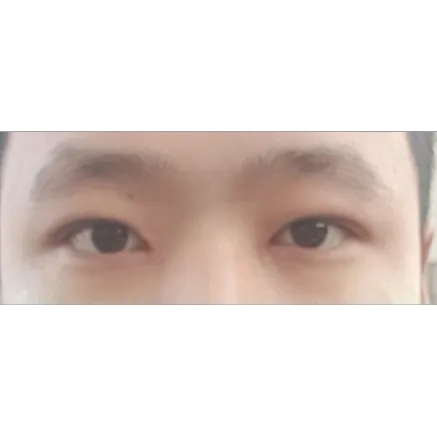 Revision ptosis correction, Epicanthoplasty — Afternoon Plastic Surgery 2