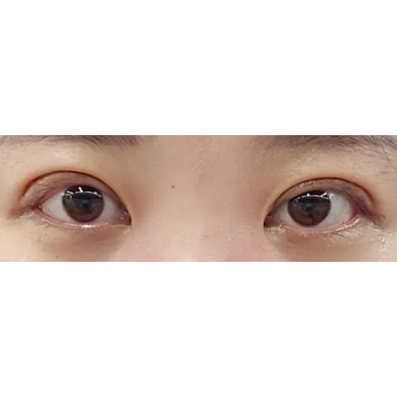 Puffy Eyelid Correction — Afternoon Plastic Surgery 2