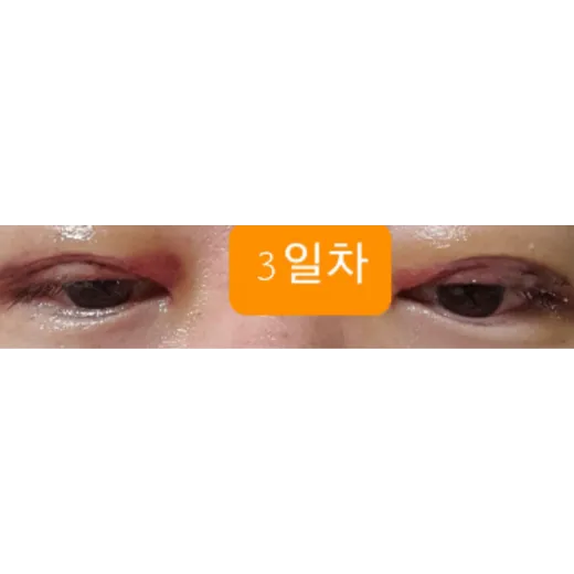 Puffy Eyelid Correction, Revision ptosis correction — Afternoon Plastic Surgery 2
