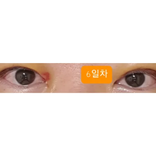 Puffy Eyelid Correction, Revision ptosis correction — Afternoon Plastic Surgery 3