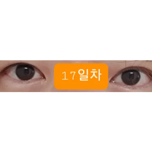 Puffy Eyelid Correction, Revision ptosis correction — Afternoon Plastic Surgery 4