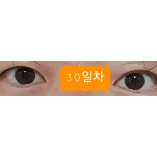 Puffy Eyelid Correction, Revision ptosis correction — Afternoon Plastic Surgery 5