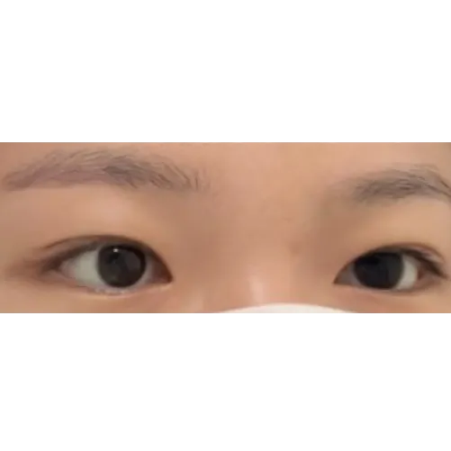 Non-incisional double eyelid surgery — Afternoon Plastic Surgery 2